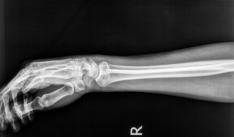 Surgery May Improve Outcomes in Arm Fractures