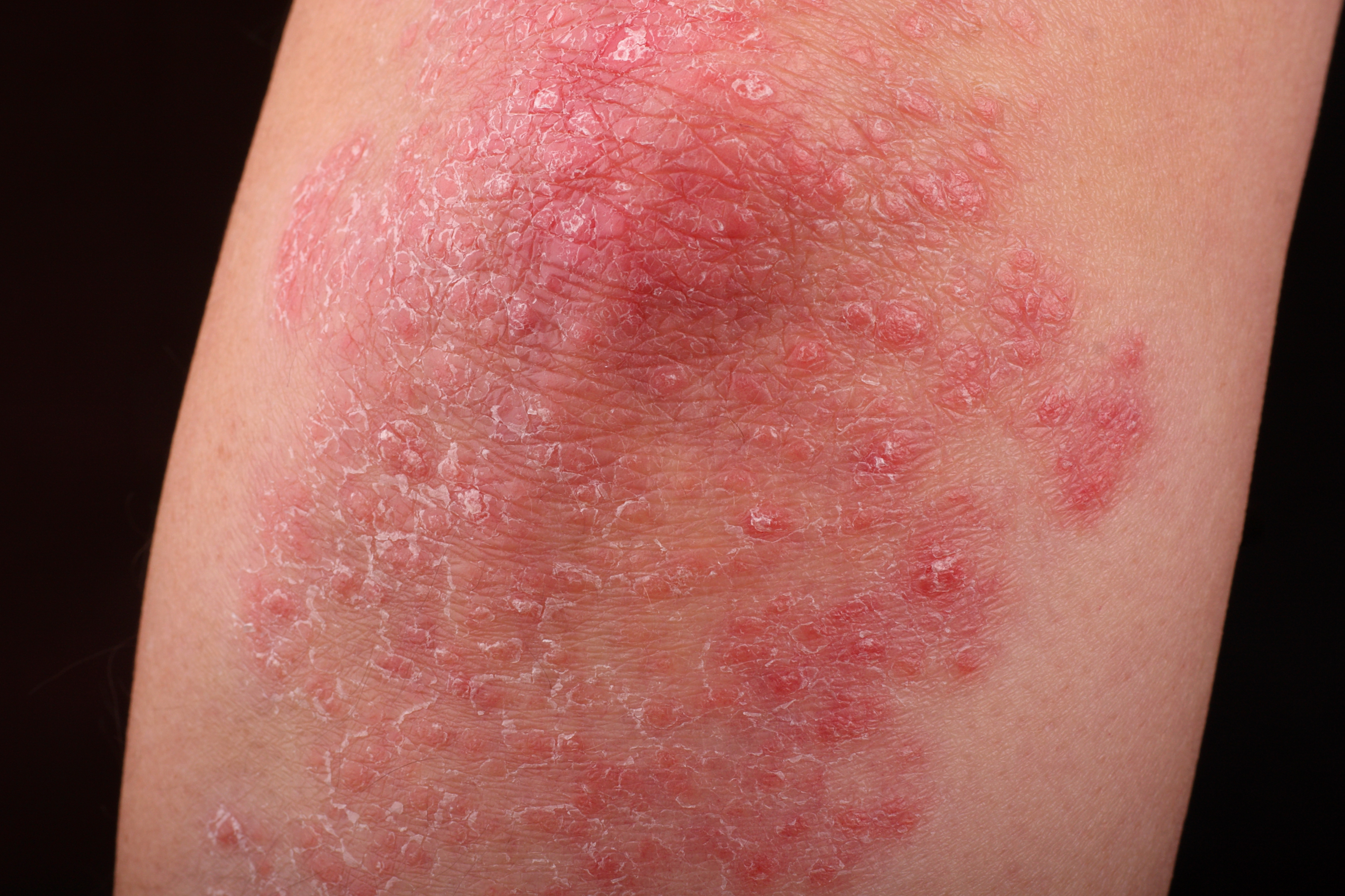 tirzepatide psoriasis Better Together: Lilly's Ixekizumab Plus Produces Superior Efficacy in Adults With Active PsA and Obesity or Overweight Combination Therapy Shows Potential in